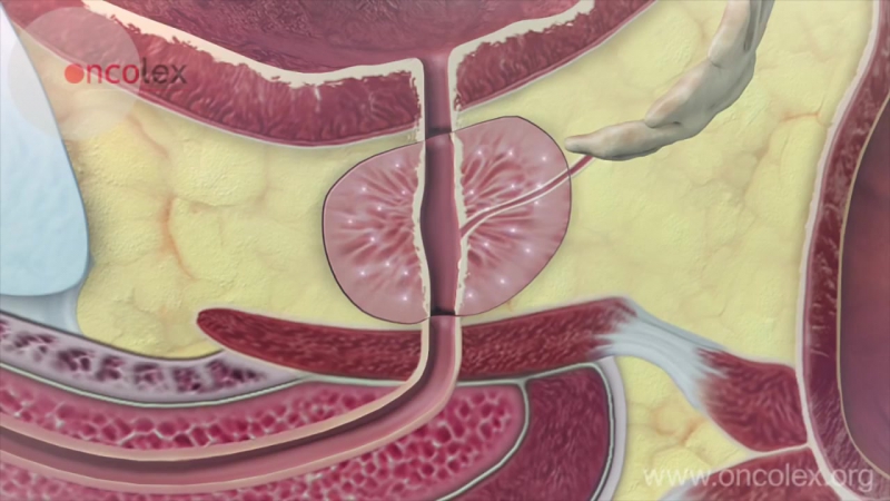 Prostate